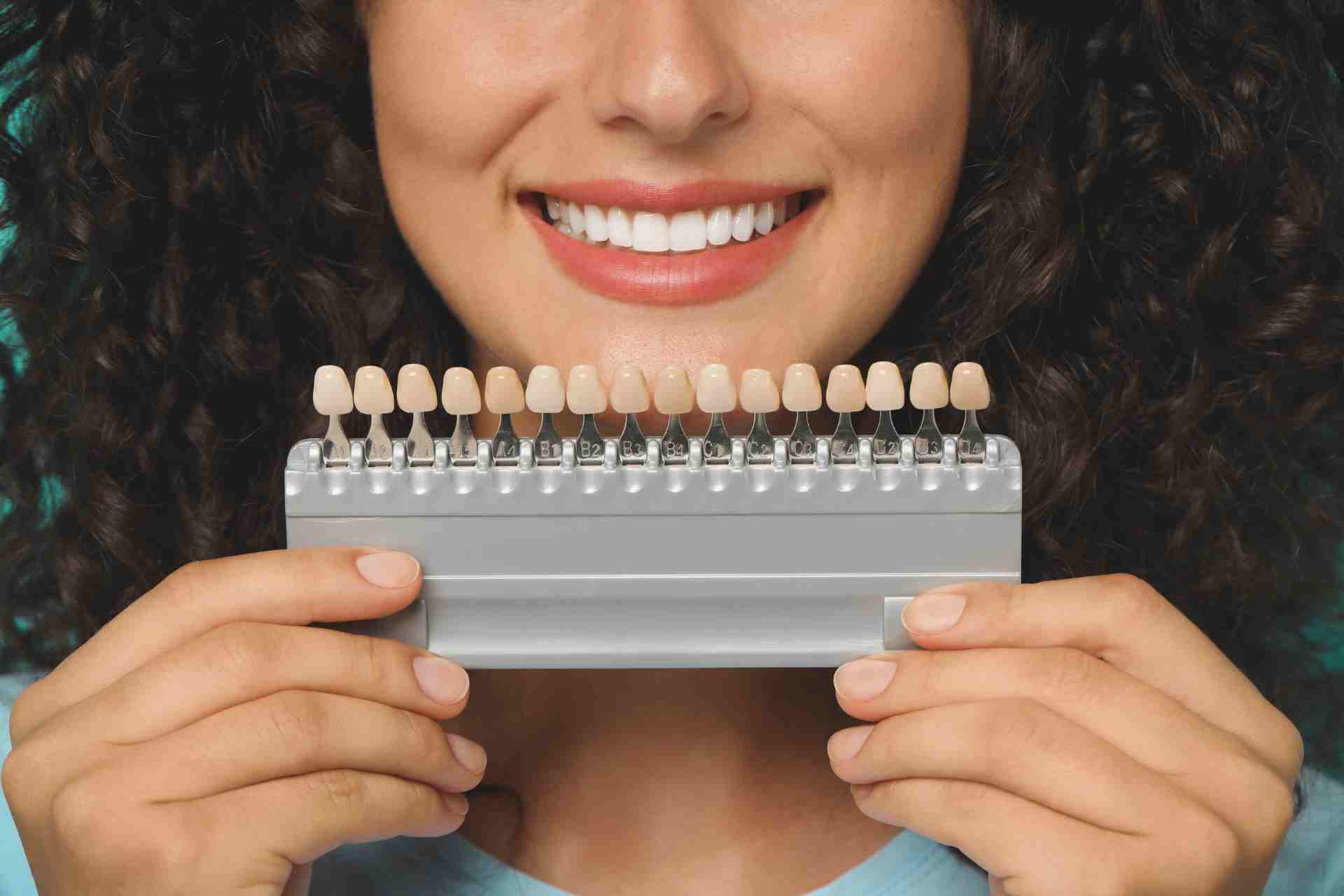 Top Big Header - How Long Do Veneers Last?