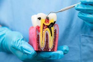 Dentist holding dental implant, artificial tooth roots into jaw, root canal of dental
