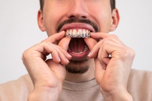 Man pressing a clear aligner tray onto his upper teeth