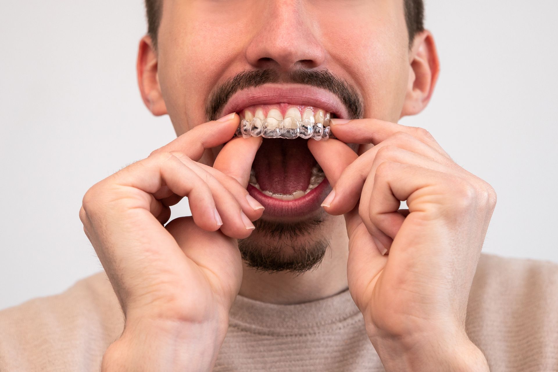 Top Big Header - How Painful is Invisalign on a Scale of 1 to 10?
