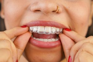 Close-up of a woman with red nails pressing a clear aligner onto her upper teeth