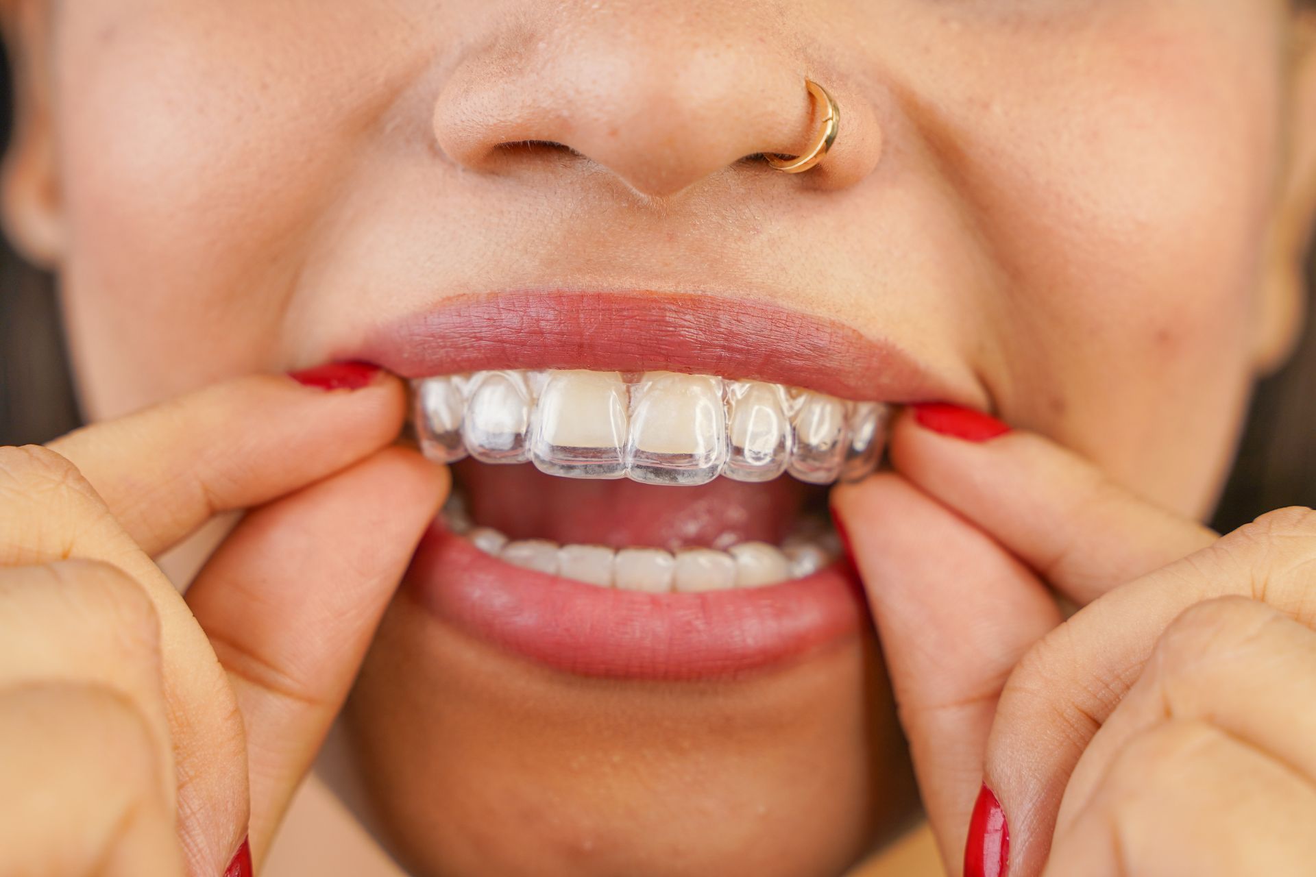 Top Big Header - Which Teeth Are Hardest to Move With Invisalign?